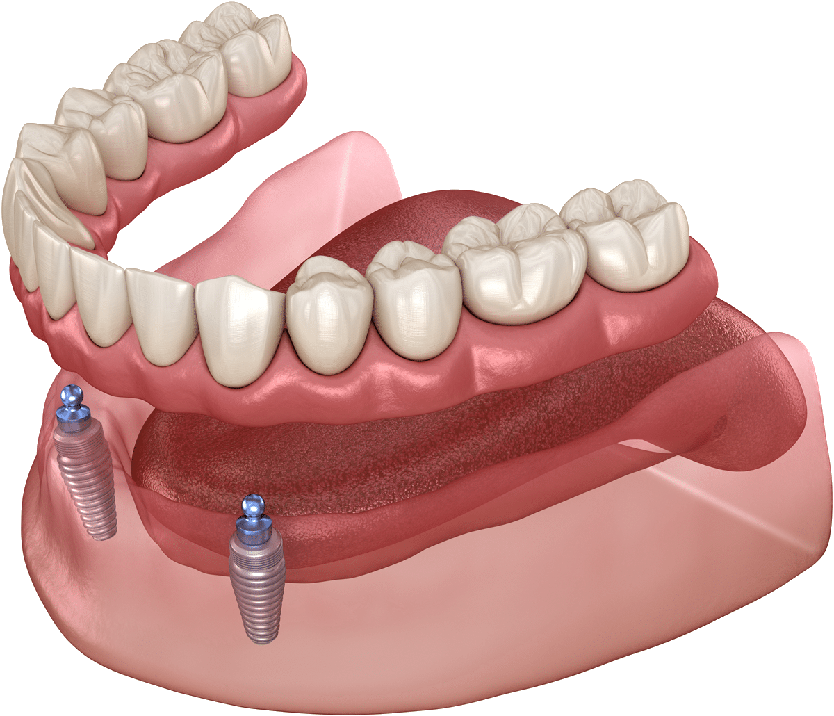 Mandibular removable prosthesis All on 2 system supported by implants with ball attachments